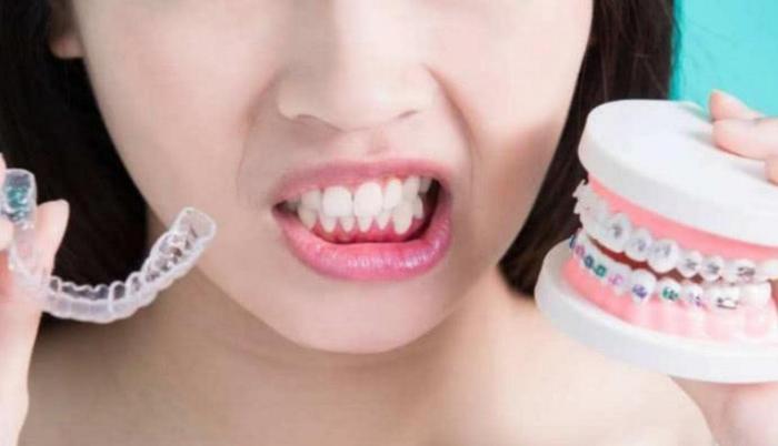 带牙套究竟是什么样的体验？过来人道出大实话，网友：心疼