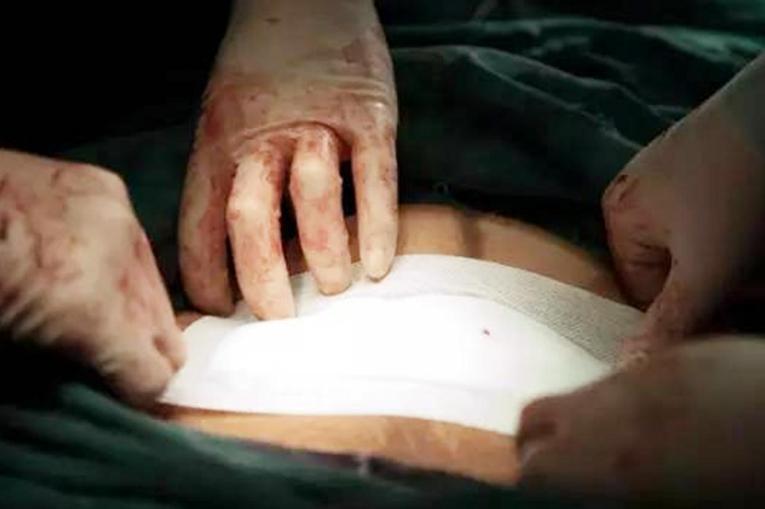 剖腹产前几天怎样缓解疼痛,如何缓解剖腹产后宫缩和伤口疼痛