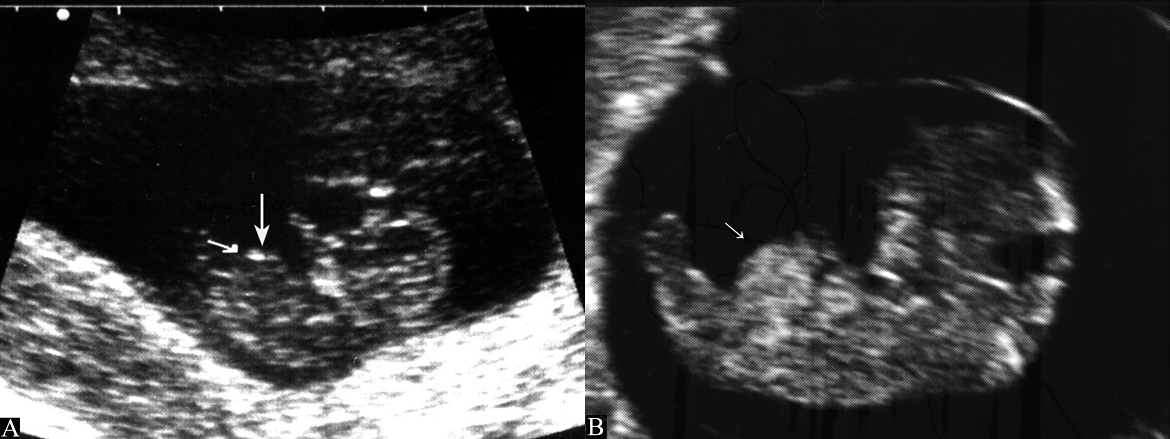 做四维彩超时胎儿动态视频,四维彩超胎儿一切都发育正常