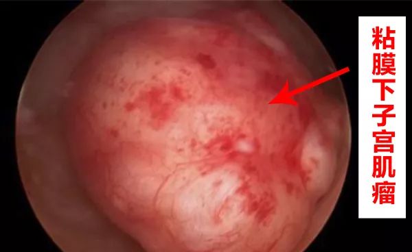 反复异常阴道出血？这个检查你需要做