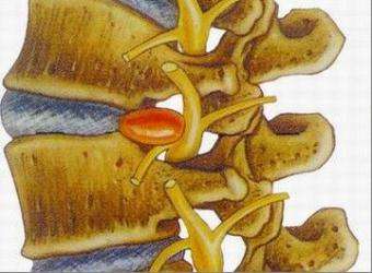 腰椎开裂腰痛的最快治疗方法,腰椎增生导致腰疼怎么理疗