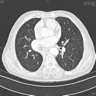 76岁老人咳嗽发烧6天,一查竟是「肺错构瘤」长在支气管里