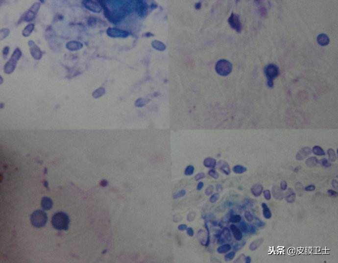 马拉色菌毛囊炎怎么得的,马拉色菌毛囊炎严重表现
