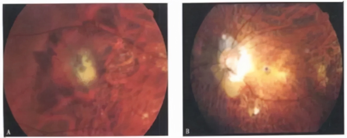 十三岁高度近视能做巩膜加固术吗,后巩膜加固术提高视力