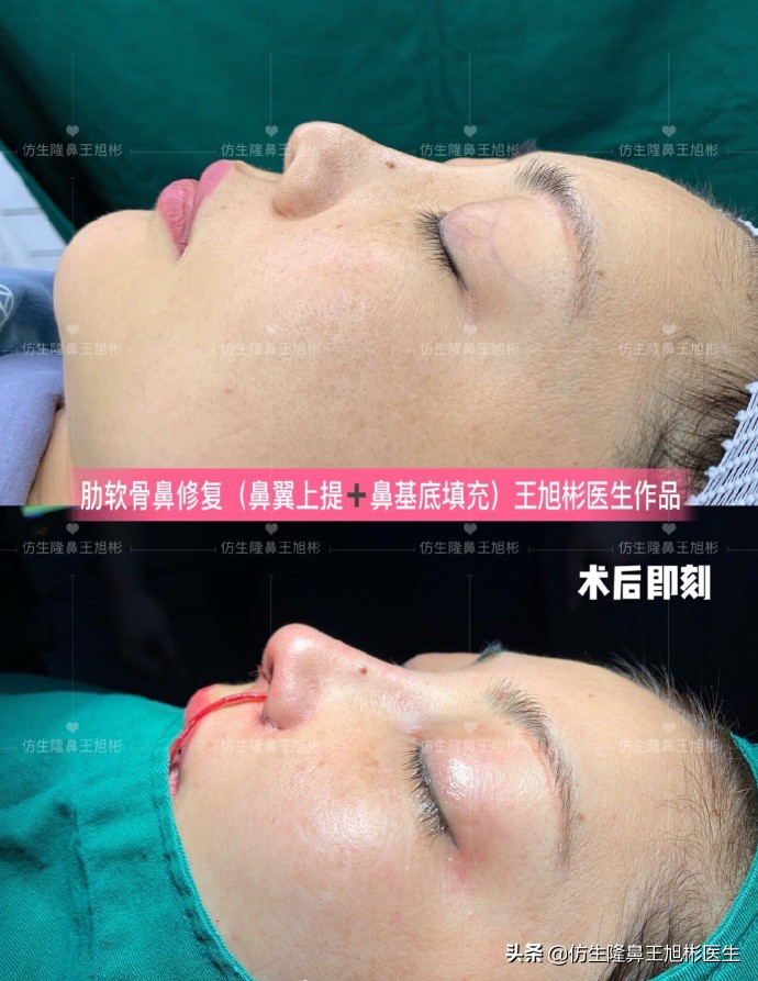 耳软骨隆鼻鼻小柱也是用耳软骨吗,耳软骨隆鼻可以摸到鼻尖的软骨吗