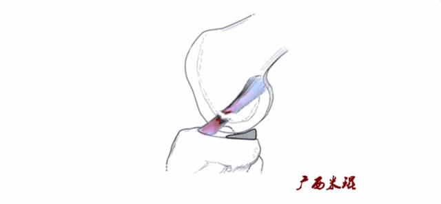 有关半月板的疾病与治疗,听骨科医生讲的话