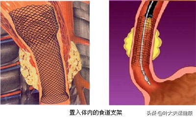 食管癌出现食管瘘怎么办,食管癌放疗后食管气管瘘原因