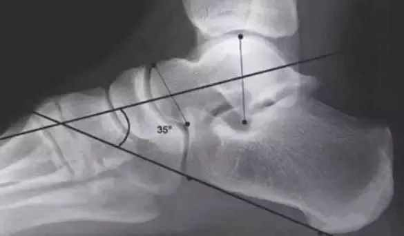 足弓不好的步态问题,如何改善足弓往里弯