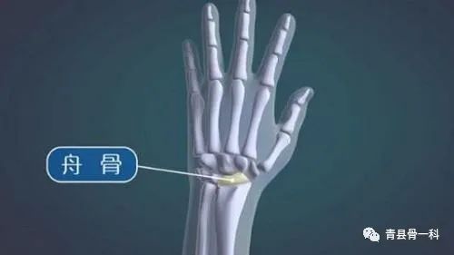 腕舟骨骨折不错位能自愈吗,手部腕舟骨骨折为什么不易愈合