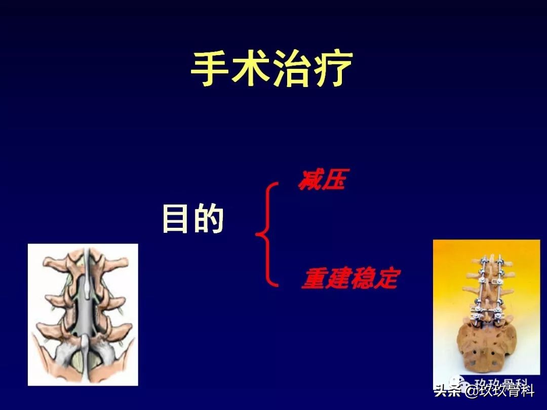腰椎不稳最坏的结果,腰椎不稳的最佳治疗方法
