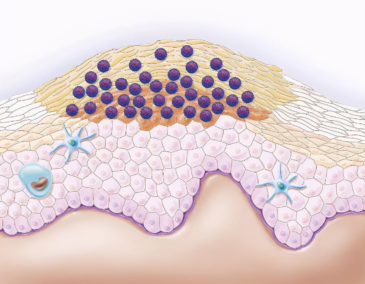 hpv持续感染3年多了不转阴怎么办,hpv高危52阳性持续2年未转阴