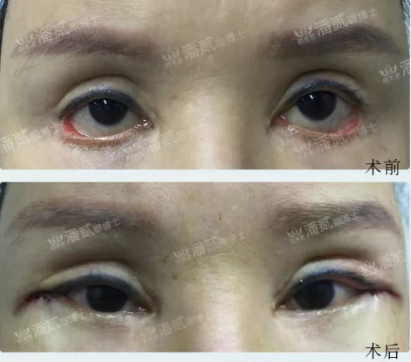 下三白眼长大后会改善吗,下三白眼的人如何手术矫正