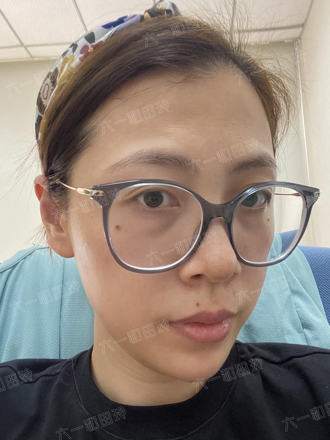 带娃长期熬夜的眼袋怎么去除,女人35岁以后一熬夜眼袋深怎么办