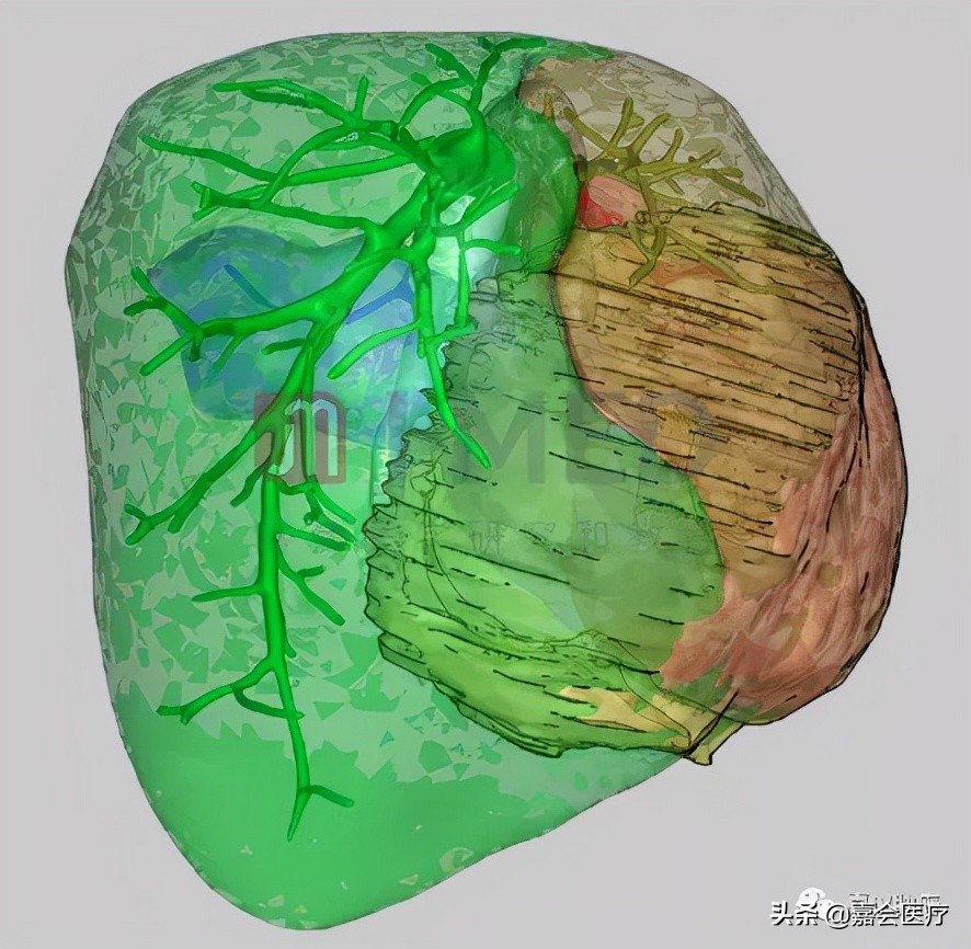 7mmx5mm肝癌能治愈吗,巨大型肝癌的治疗方法