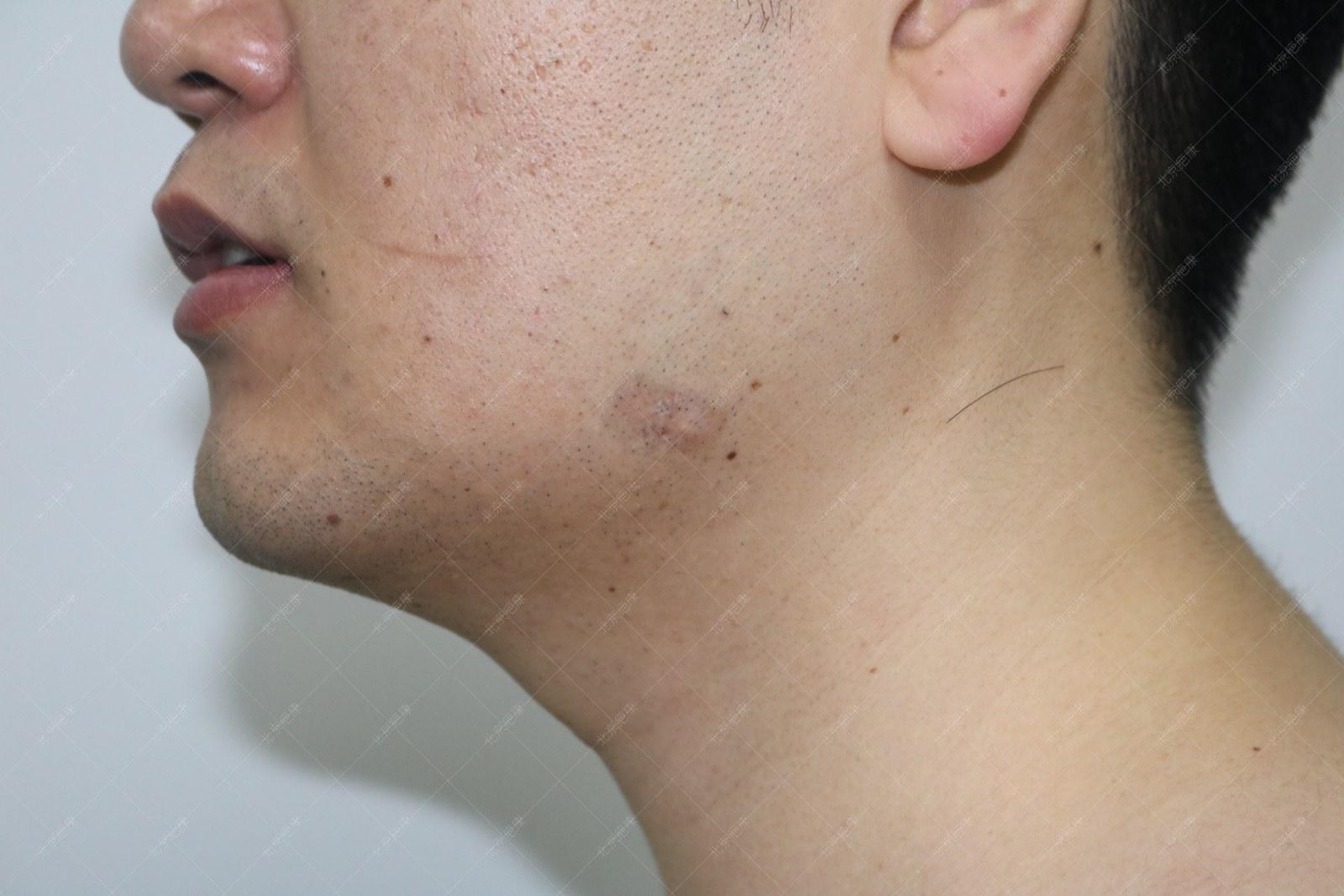 疤康医疗治疤痕疙瘩靠谱吗,乐疤康祛除疤痕有效果吗