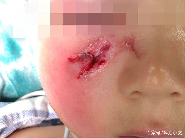 小孩经常受伤怎么办,孩子不小心受伤情况有哪些