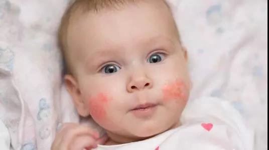 宝宝湿疹反反复复预防护理有技巧,3个月宝宝湿疹反反复复怎么根除