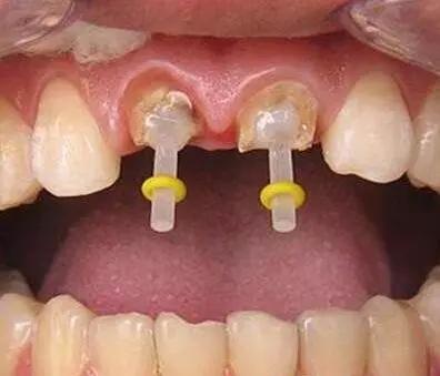 什么是牙齿打桩桩冠修复的步骤,牙齿根管治疗和打桩的区别