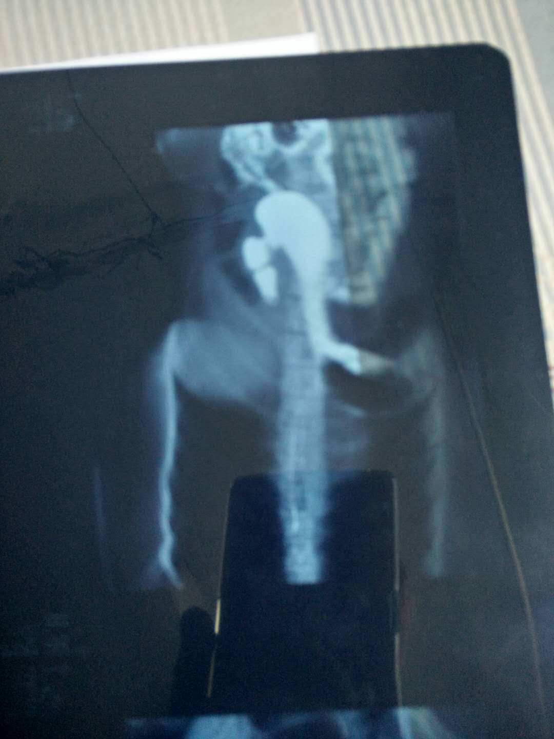 贲门失弛缓症不吃饭也噎得慌,酸导致的胸口痛是贲门没关上吗