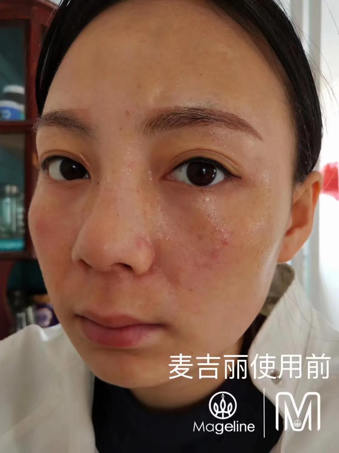 甜甜专业祛斑祛痘,甜甜祛斑直播间