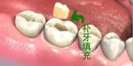 补牙视频过程医生视角,补牙真实全过程