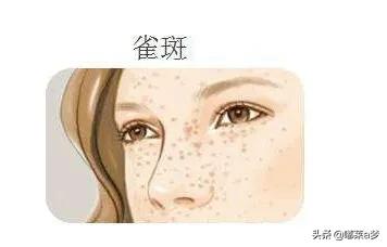 雀斑晒斑怎么去除中医,晒斑怎么祛斑最有效既省钱又简单