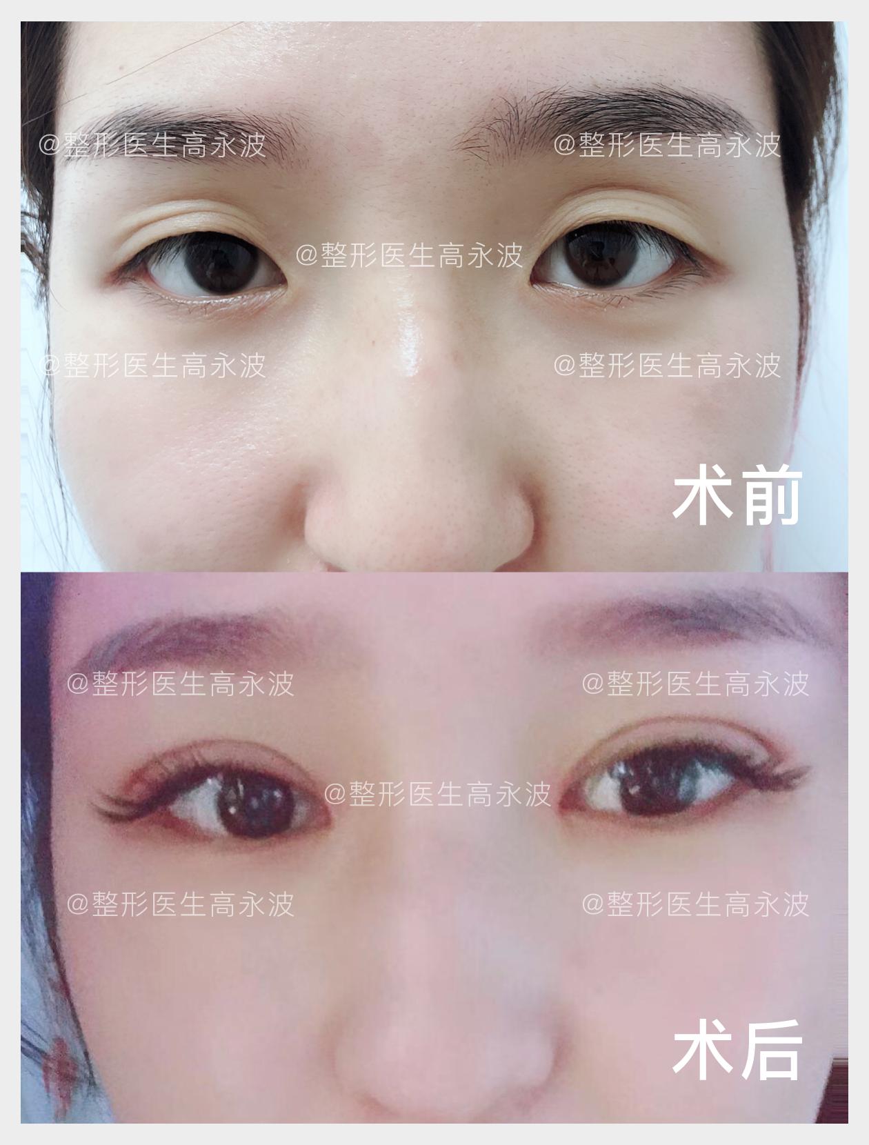 韩式双眼皮宽了怎么修复,双眼皮割宽了还可以做修复吗