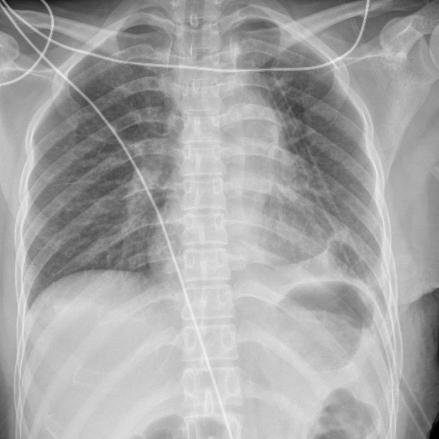 早筛早诊防肺癌,肺癌早诊早治可治愈