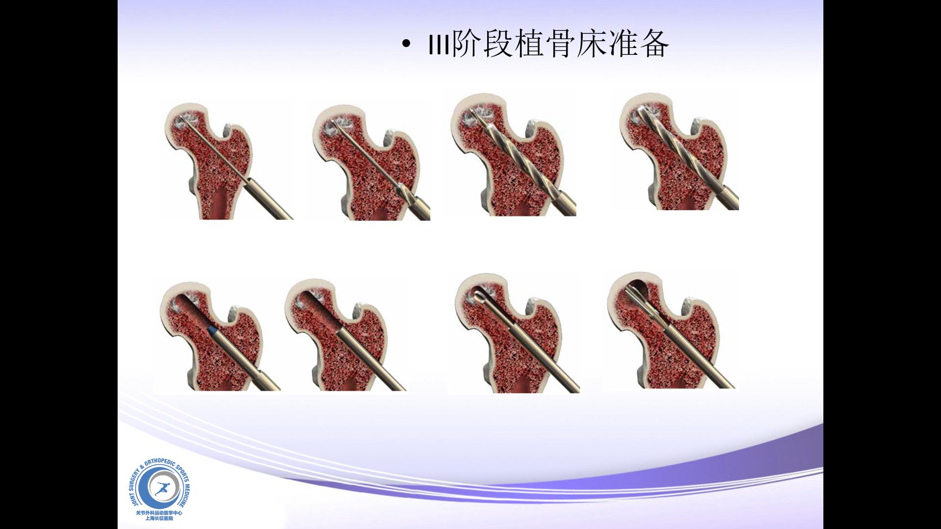 什么情况下会出现股骨头坏死,儿童股骨头坏死和成人股骨头坏死