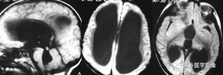 脑室影像学表现,脑室占位影像
