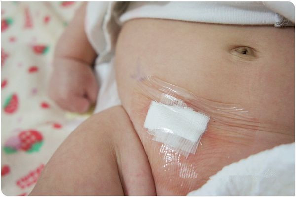 53天宝宝腹股沟疝气哭闹怎么办,腹股沟疝气哭闹