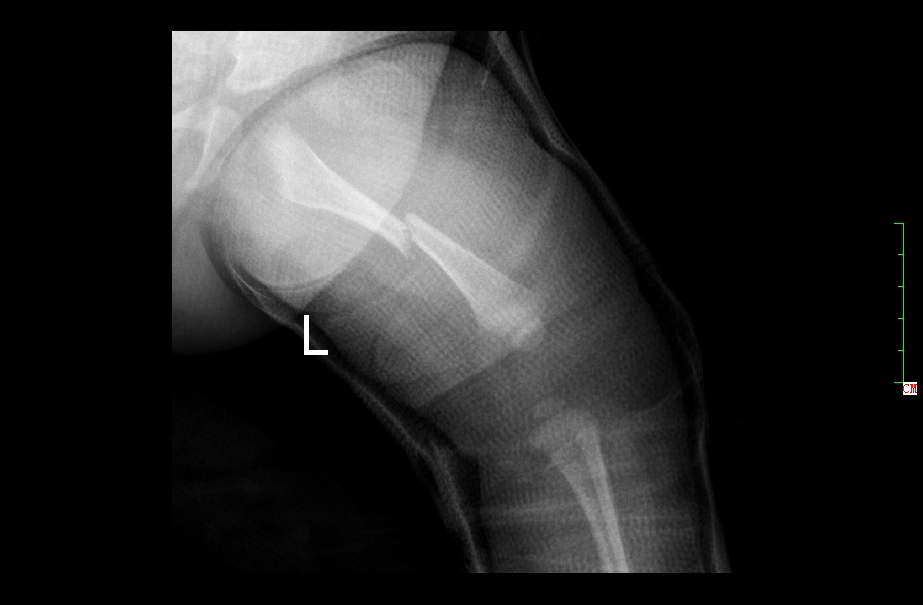 幼儿骨折误区,儿童骨折为什么好得快