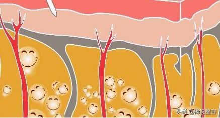 大腿吸脂术前要做检查多少钱,俩胳膊俩大腿做吸脂手术要多少钱