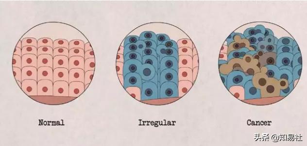 羞羞后警惕HPV感染,一不小心会得宫颈癌