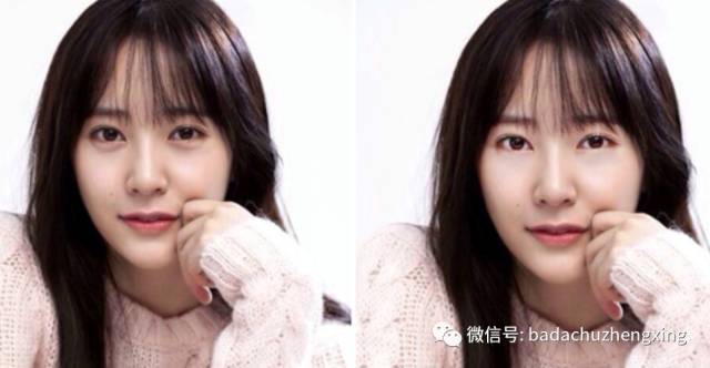 眼袋怎么变卧蚕整形图片,外切眼袋保留卧蚕怎么没有卧蚕呢