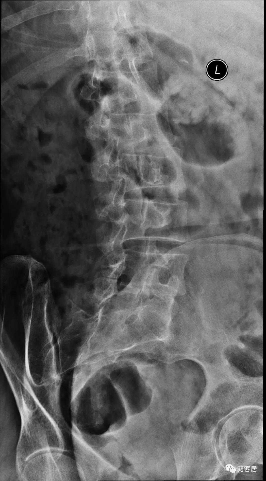小针刀扎到坐骨神经会瘫痪吗,小针刀会切断坐骨神经吗