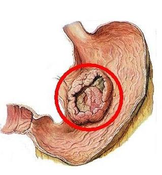 癌症会传染吗？医生说：一般是不会，但是这3种要区别对待