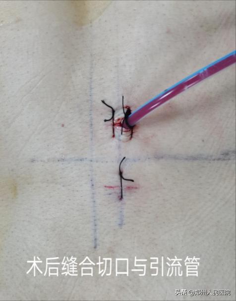 对骨科微创技术的认识,骨科手术与保守治疗对比