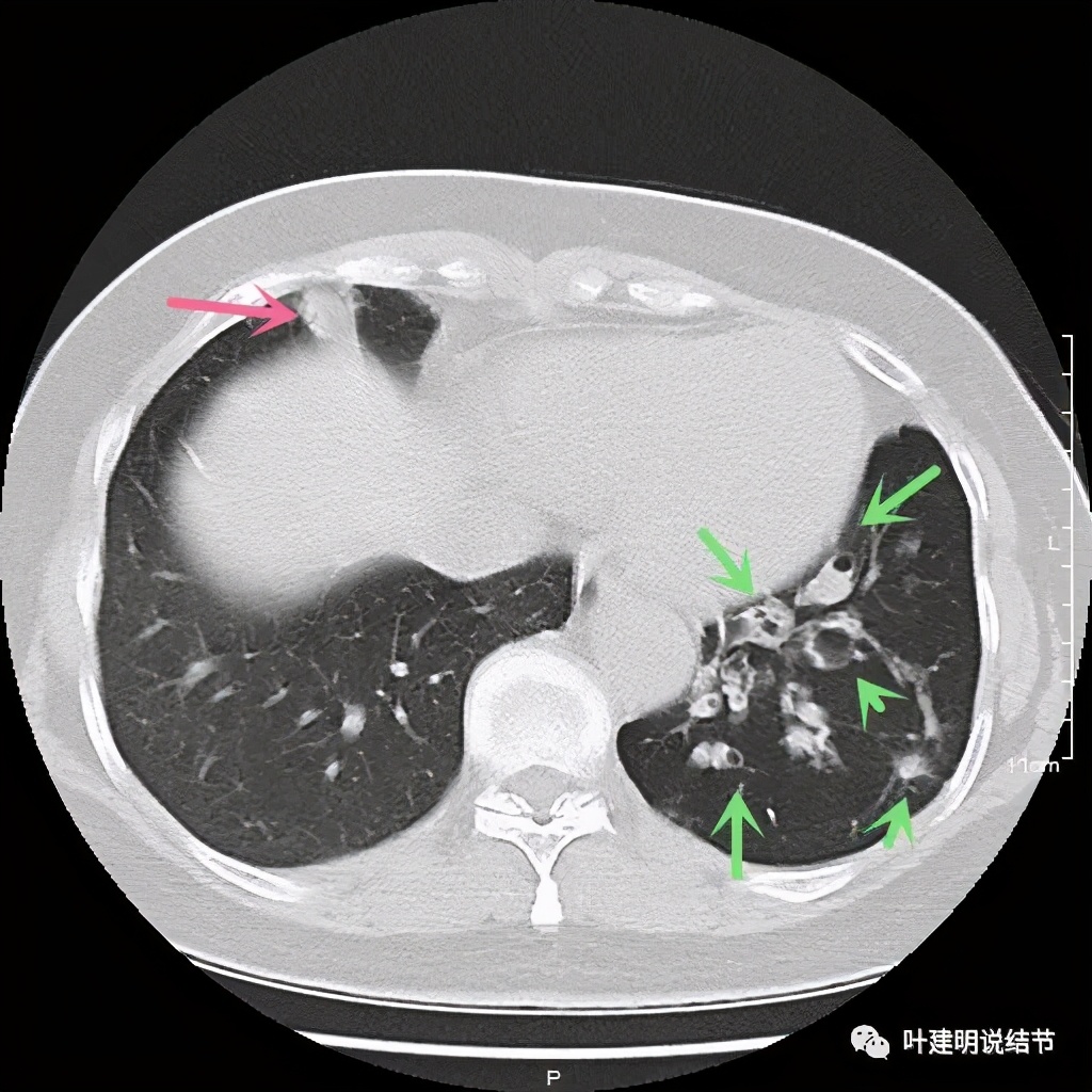 这样的实性结节伴小空洞会是肺癌吗?