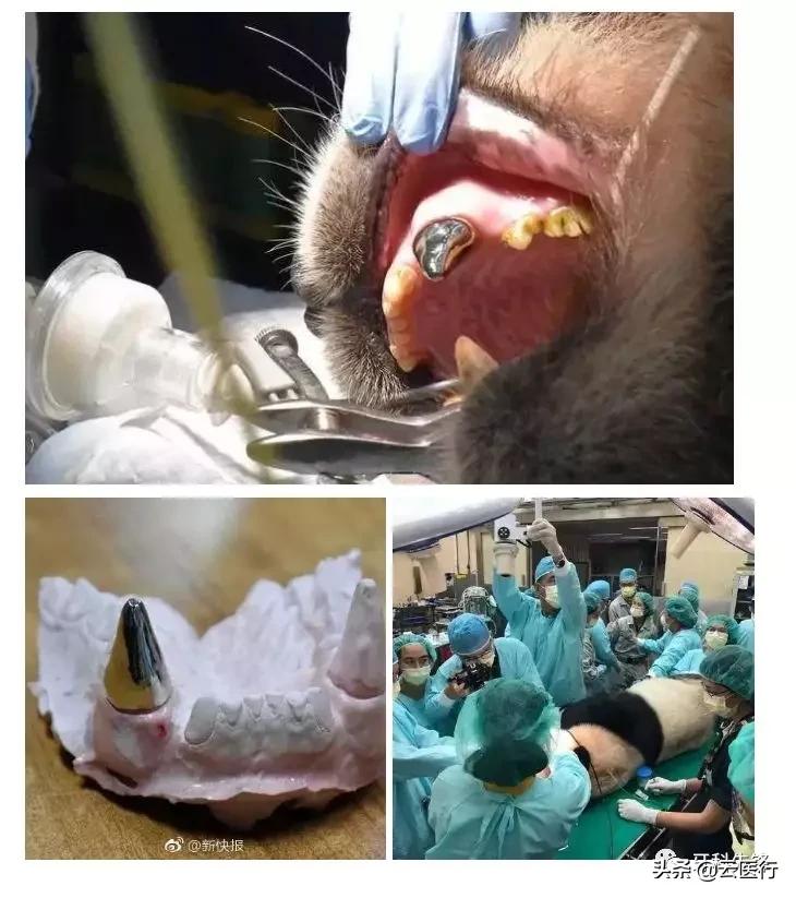 根管治疗后戴牙冠要磨两边的牙,牙齿根管治疗后必须戴牙冠吗