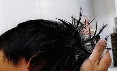 头皮屑是怎么形成的应该怎样去除,头皮屑多怎么去除头皮屑
