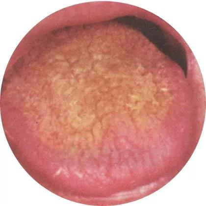 胃阴虚内热加脾虚湿热怎么调,胃强脾弱导致积食内热怎么调理