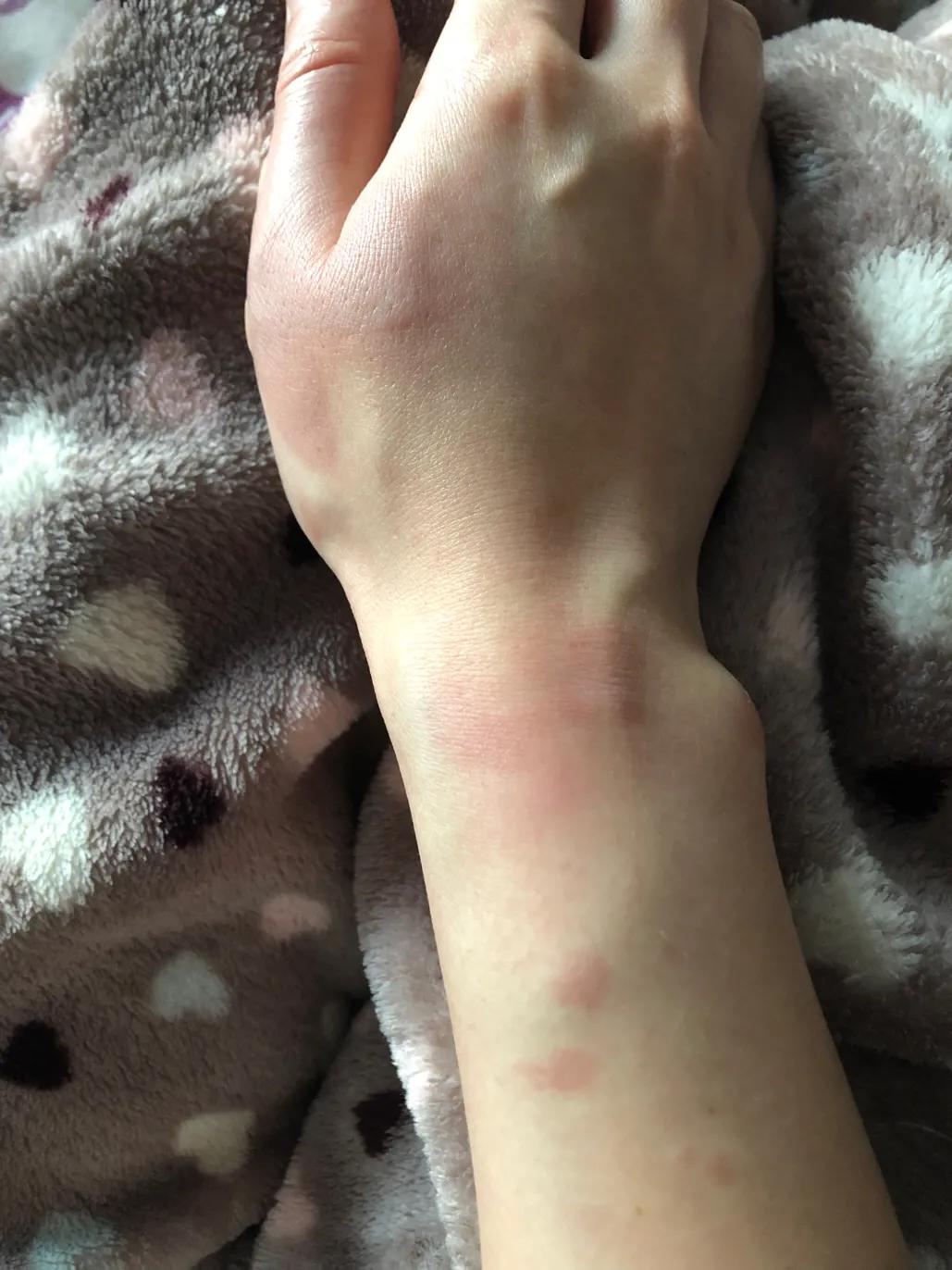 疫情期间低温烫伤的水泡怎么处理,烫伤后二十二天基本都平了