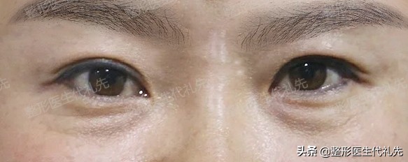 去眼袋一问一答,祛眼袋要咨询什么问题