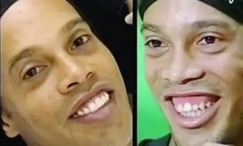 牙齿深覆合对脸型的影响,覆合型牙齿是怎么造成的