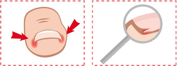 脚指甲两边向肉里扎,指甲小知识大全