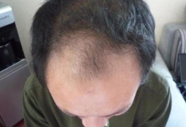 世界首家头发银行开业:冷冻头发样本,若秃顶可把细胞注射回头皮