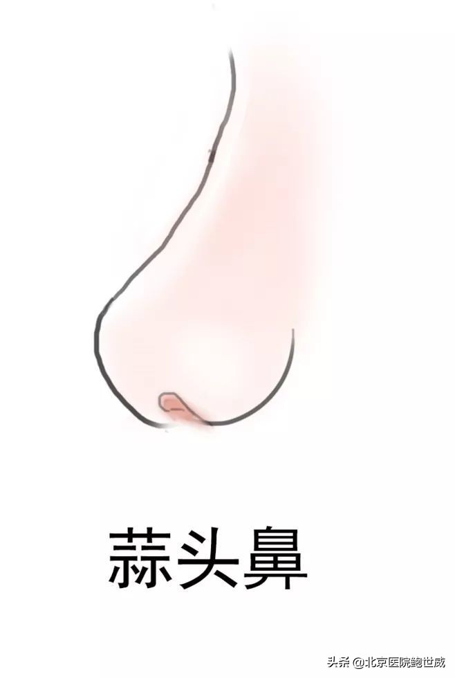 天生鼻型不完美怎么办呢,八种鼻型不佳图片