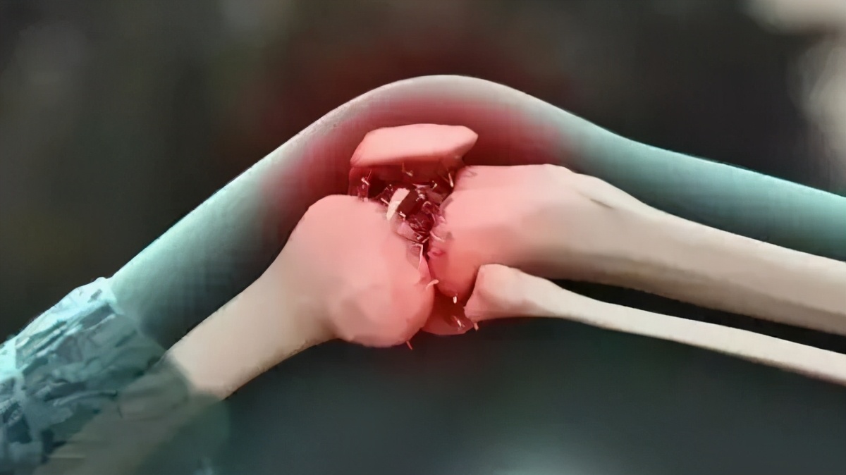 关节咔咔响是什么原因引起的,关节咔咔响的人要注意了