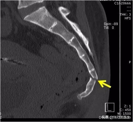我的尾巴骨一坐下就疼,人体尾巴骨疼咋回事